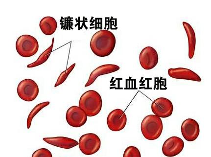 锻炼也能预防贫血的发生