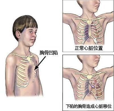 漏斗胸手术后复发