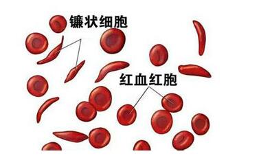 自身免疫力溶血性贫血容易复发吗