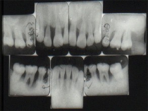 牙周炎晚期如何治疗