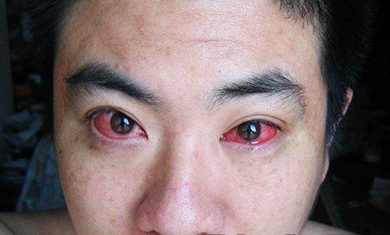 红眼病治疗后怎么预防复发