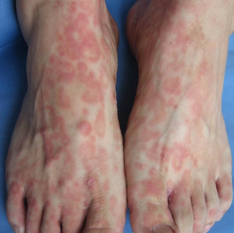 患有梅毒会致死吗