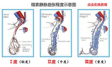 精索三度.jpg