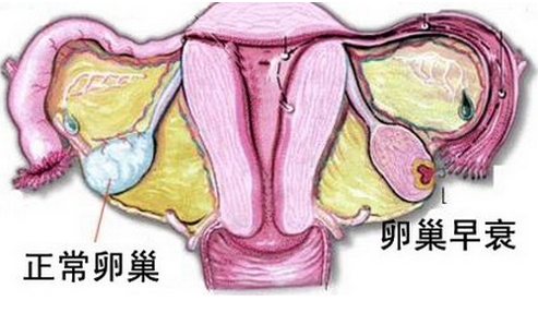 卵巢早衰图.png