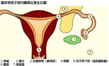 哪个年龄段的人易出现子宫内膜异位