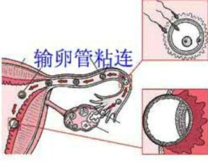 输卵管粘连1.jpg