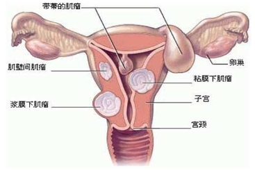 子宫腺肌症怀孕几率比较低
