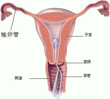 输卵管检查.jpg