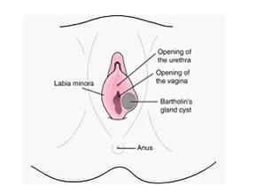 前庭大腺囊肿吃什么消炎药可以缓解