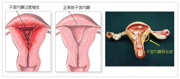绝经后女性查出子宫内膜增厚怎么办