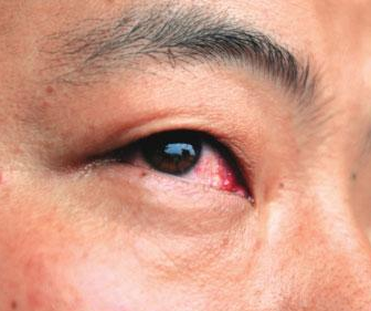 眼睛结膜炎反复发作怎么办