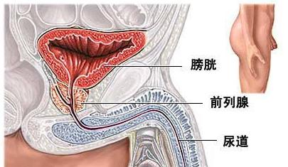 慢性前列腺钙化治愈率高吗