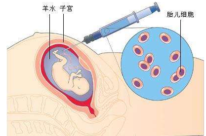 胎膜早破手术费用贵吗