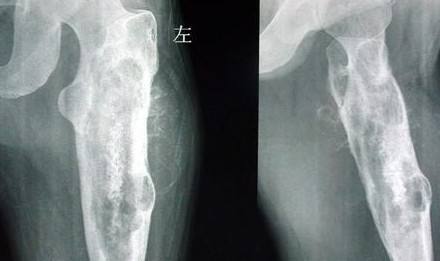 骨肉瘤 www.fh21.com.cn