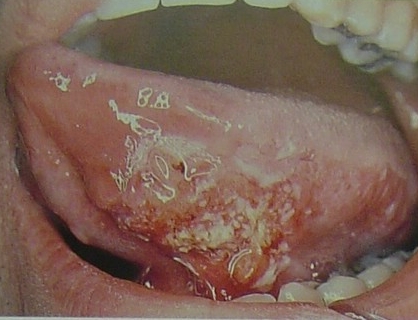 舌癌常合并感染,晚期常并发组织坏死,出血,吸入性肺炎.
