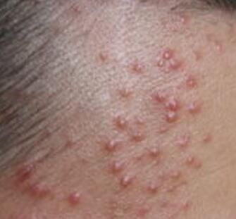 大面积毛囊炎费用需要多少