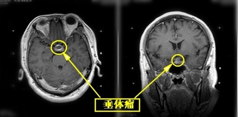 垂体瘤是怎样引起的