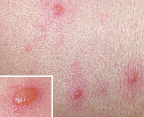 病毒性带状疱疹有什么症状表现