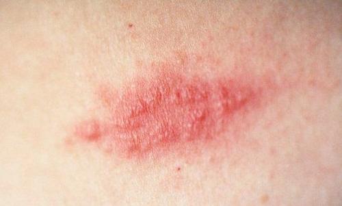 带状疱疹症状表现是什么