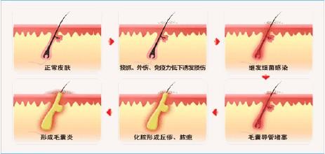 毛囊炎饮食注意什么