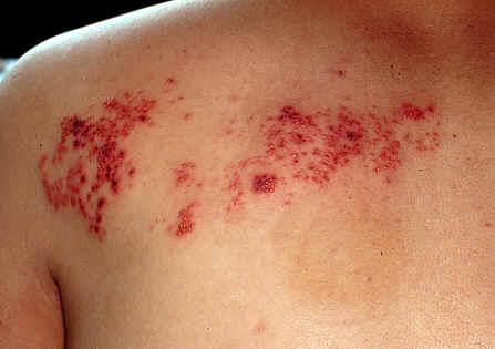 皮肤科 带状疱疹 症状 春秋两季是皮肤病的高发季节,一是这两季