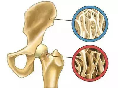 2019骨质疏松症人口_哪些人是骨质疏松高发人群