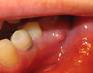 牙龈癌的临床表现有哪些