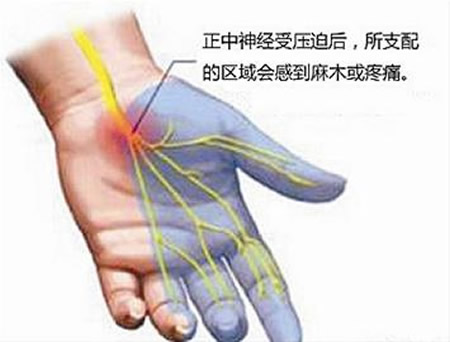 湿热性末梢神经病变的预防方法是什么