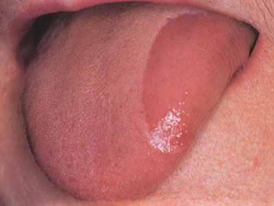 舌炎的治疗方法有哪些