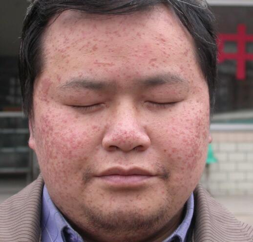 扁平疣如何检查确诊_飞华健康网