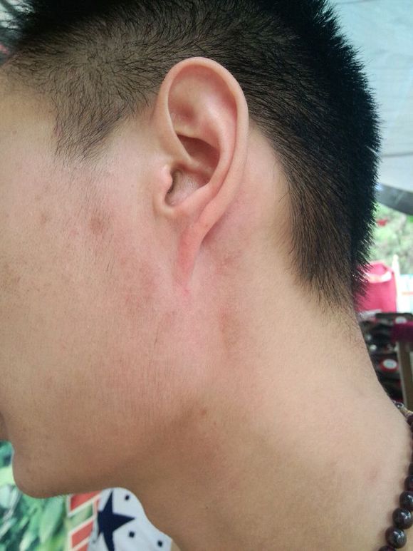 神经性皮炎治疗期间可以喝酒吗