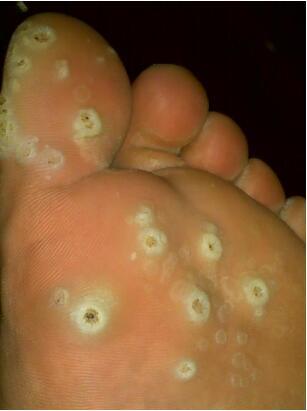 鸡眼是一种什么样的疾病