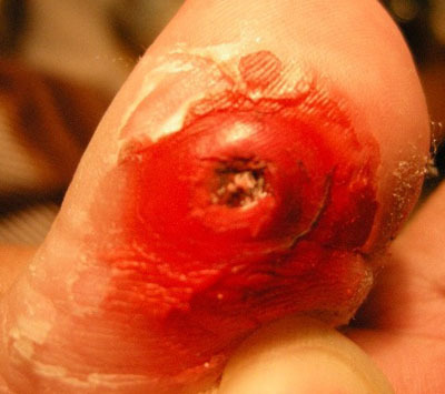 鸡眼会有什么样的症状