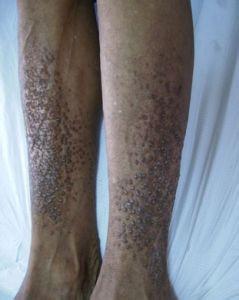 诊断 发生于小腿伸侧及头皮的慢性限局性肥厚性银屑病,类似神经性皮炎