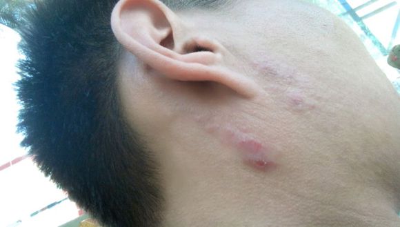 神经性皮炎患者晚期吃什么好