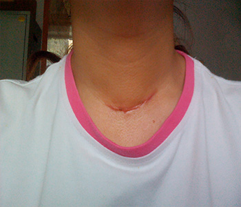 去疤痕手术有后遗症吗