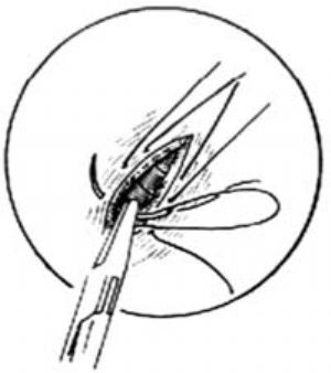鸡眼切除了之后还会复发吗