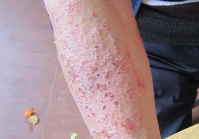 过敏性皮炎的食疗方法