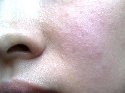 在皮肤过敏上很多人的表现是不一样的,皮肤过敏有何症状呢?