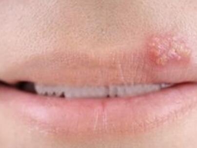 患上口唇疱疹有哪些具体的症状_飞华健康网