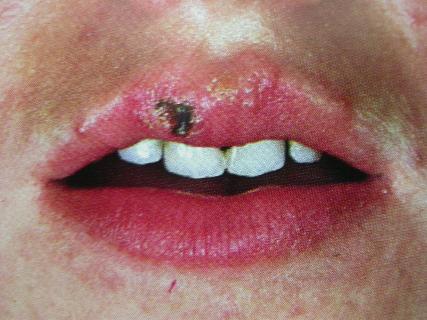 口唇疱疹一定是病毒性的吗