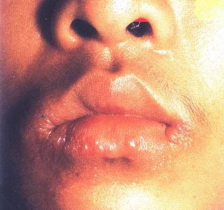 口唇疱疹是传染性皮肤病