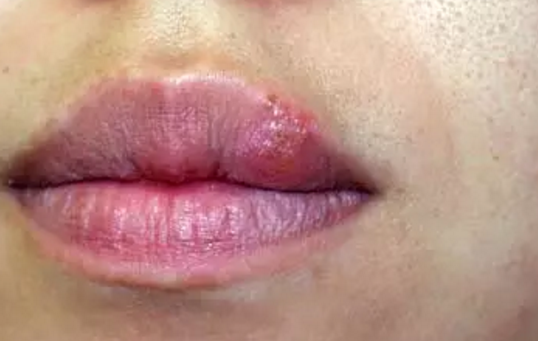 手术怎么治疗口唇疱疹