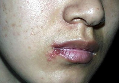 口唇疱疹最佳治疗方法是什么