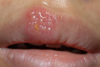 口唇疱疹的预防方法