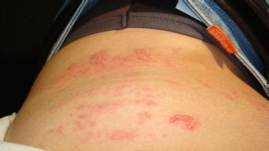 患了痒疹是什么样的症状