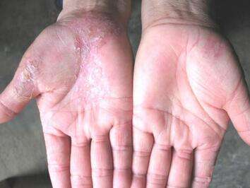 看皮肤癣一般需要多少费用_飞华健康网