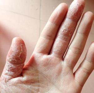 > 皮肤科 > 手癣 > 概况  症状:手癣的初起损害为指端,指屈或掌面发生