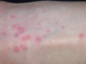 结节性痒疹的治疗方法是什么