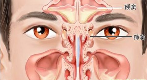 鼻窦炎手术后的护理方法是什么